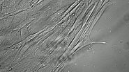 'Alzheimer's in a Dish' model induces skin cells into neurons expressing amyloid-beta