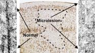 'Microlesions' in epilepsy discovered by novel technique