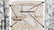 Microlesions in epilepsy discovered by novel technique