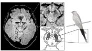 Tell-tail MRI image diagnosis for Parkinsons disease