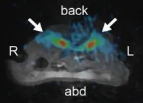 23Na MRI technique unleashes new approach for diagnosing diabetic kidney disease 2