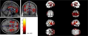 A breakthrough in diagnosing hydrocephalus: Multimodality approaches enhance accuracy and reduce costs