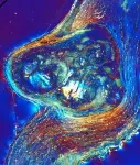 A heart of stone: Study defines the process of and defenses against cardiac valve calcification 2