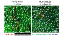 A new study reveals a key mechanism driving atherosclerosis in Hutchinson-Gilford Progeria Syndrome 2