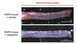 A new study reveals a key mechanism driving atherosclerosis in Hutchinson-Gilford Progeria Syndrome 3