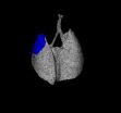 A new tool to confront lung cancer 2