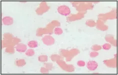 A novel chromosomal abnormality in AML patient: Case report and literature review