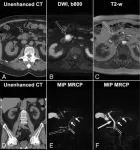 A promising future in pancreatic incidentaloma detection