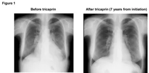 A simple supplement improves survival in patients with a new type of heart disease