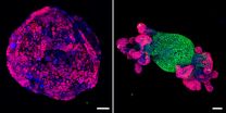 A single gene turns colorectal cancer cells back into normal tissue in mice