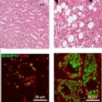 A stem cell based cell culture model for nonalcoholic fatty liver disease