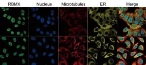 Aberrant RBMX expression relevant for cancer prognosis and immunotherapy response