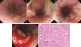 Achalasia and esophageal cancer: A case report and literature review