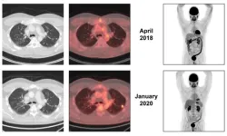 Activity of pazopanib in EWSR1-NFATC2 translocation-associated bone sarcoma