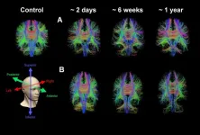 Advanced MRI scans help identify one in three concussion patients with ‘hidden disease’