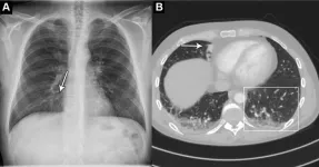 AI accurately identifies normal and abnormal chest x-rays