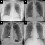 AI accurately identifies normal and abnormal chest x-rays 2