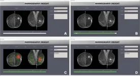 AI bias may impair radiologist accuracy on mammogram