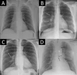 AI can help rule out abnormal pathology on chest x-rays