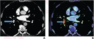 AI cuts CT turnaround, wait times for positive pulmonary embolus