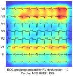 AI-driven study redefines right heart health assessment with novel predictive model