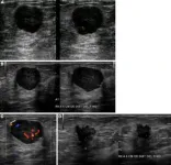 AI helpful in triaging breast masses in low-resource areas 2