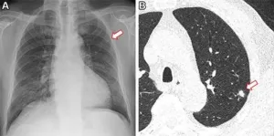 AI identifies non-smokers at high risk for lung cancer