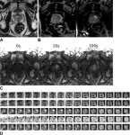 AI model effective in detecting prostate cancer