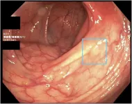 AI technology for colon cancer detection shows promise for widespread use – in the future