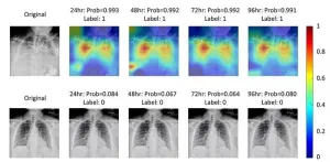 AI to predict critical care for patients with COVID-19