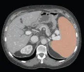 AI with volumetric thresholds facilitate opportunistic screening for splenomegaly