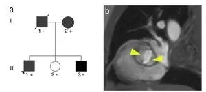 An international team identifies the mutations that cause the most frequent congenital heart defects 2