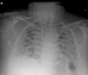 Artificial intelligence tool uses chest X-ray to differentiate worst cases of COVID-19