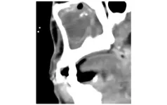 Atypical infections in chronic sinusitis: thinking outside the box