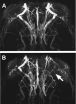 Autoantibodies damage blood vessels in the brain