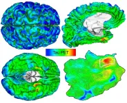 Automated imaging detects and tracks brain protein involved in Alzheimers disease