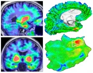 Automated imaging reveals where TAU protein originates in the brain in Alzheimers disease