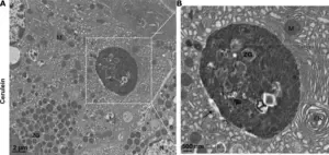 Autophagy in pancreatitis 3