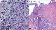 Berkeley Lab scientists find that normal breast cells help kill cancer cells