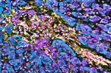 Biomarker may predict immunotherapy response in liver cancer