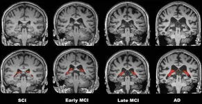 Black patients face delays in Alzheimer’s diagnosis