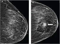 Bleeding after image-guided breast biopsies: Discontinuing vs. maintaining antithrombotic therapy