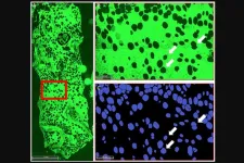 Bone marrow adipocytes provide early sign of progression from MGUS to multiple myeloma