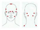 Botox injected in head trigger point is proven to reduce migraine crises