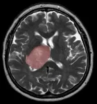 Brain cancer linked to tissue healing