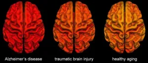 Brain changes following traumatic brain injury share similarities with Alzheimers disease