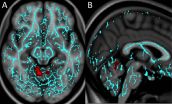 Brain injury patterns linked to post-concussion depression and anxiety 2