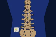 Brain scan predicts effectiveness of spinal cord surgery