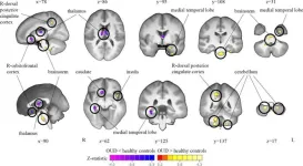 Brain volume changes seen in opioid users