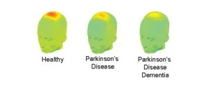 Brain waves may predict cognitive impairment in Parkinson's disease